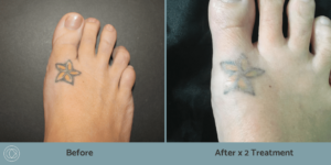 Foot tattoo before and after photo