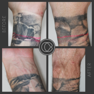 Everything You Need To Know About Laser Tattoo Removal - Clean Canvas