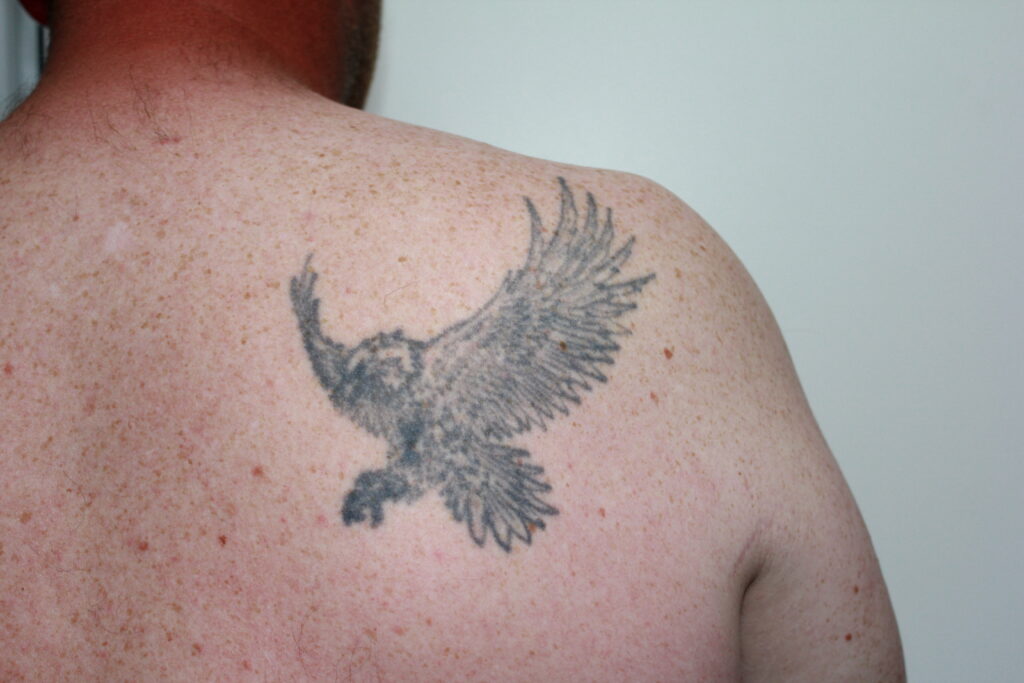 Back tattoo removal before