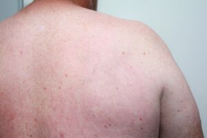 Back tattoo removal after