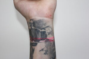 Partial wrist tattoo removal