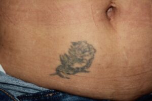 stomach tattoo removal before