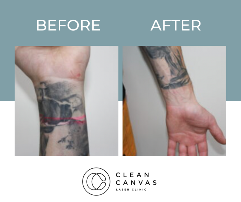 Tattoo Removal Prices In Sydney - Clean Canvas Laser Clinic
