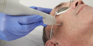 Man receiving PicoWay laser treatment on face