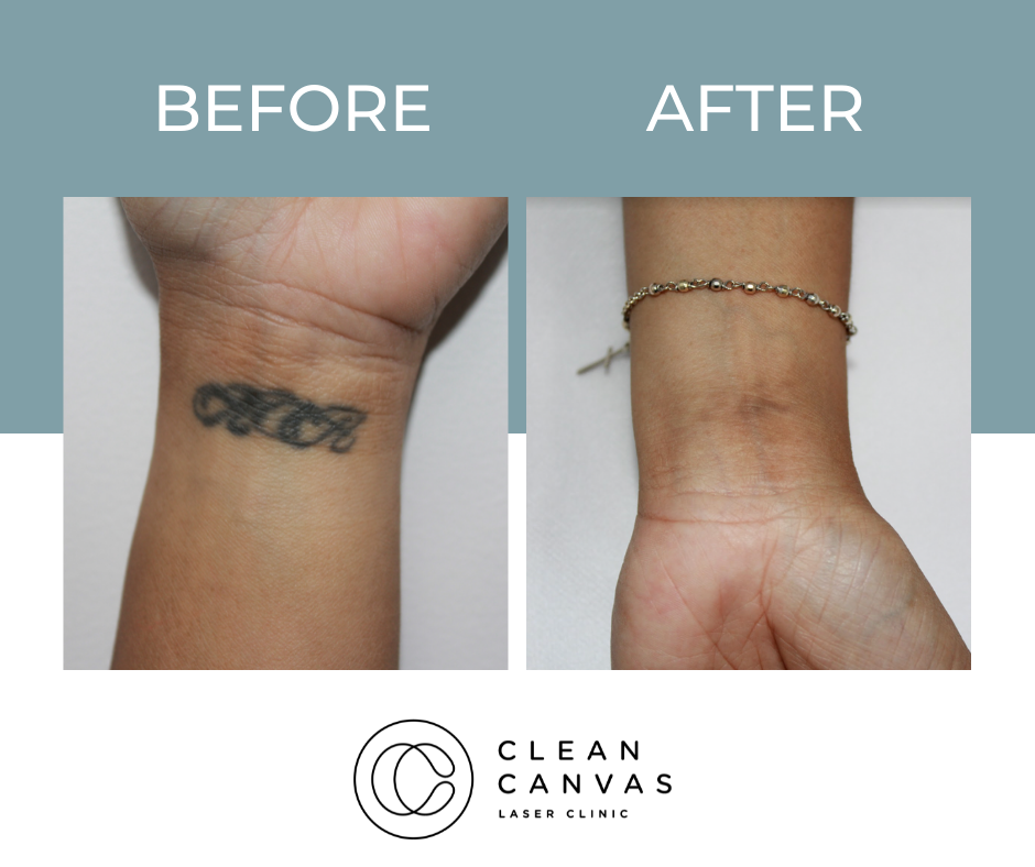 Before and after tattoo removal on wrist