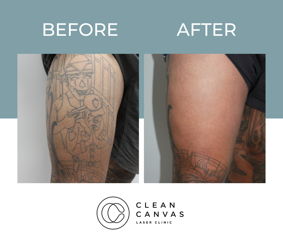 What Happens During Laser Tattoo Removal Process Fresh Skin Canvas
