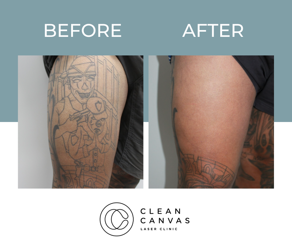 How Effective is Laser Tattoo Removal  Laser Specialists