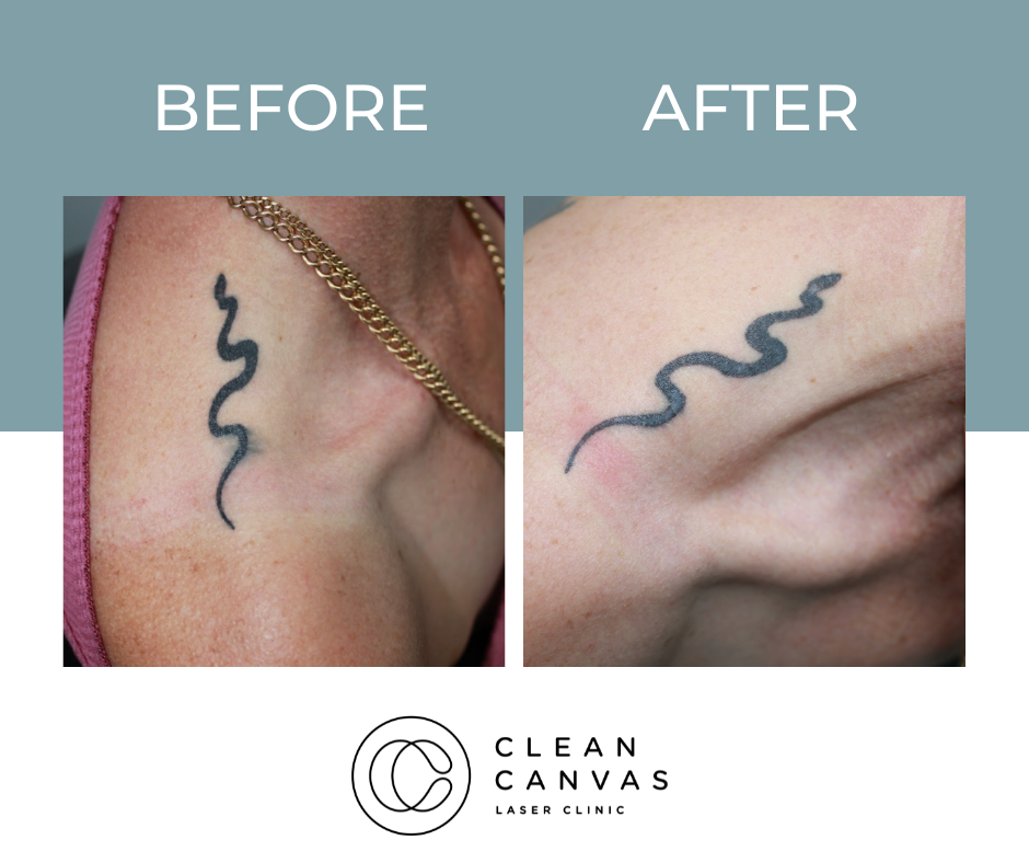 Tattoo Removal Before And After In Sydney - Clean Canvas Laser Clinic