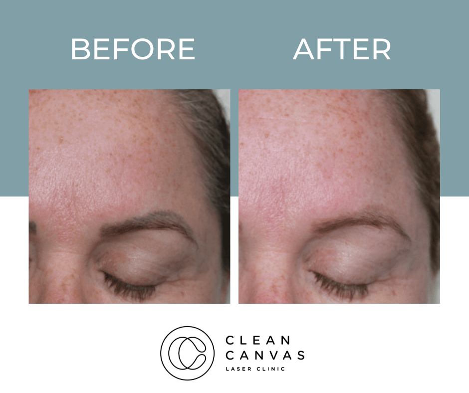 Cosmetic Eyebrow Tattoo Removal Sydney - Clean Canvas Laser Clinic