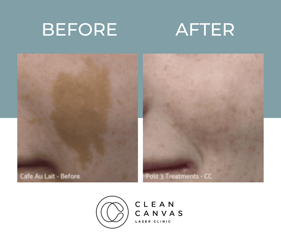 Skin treatment before and after