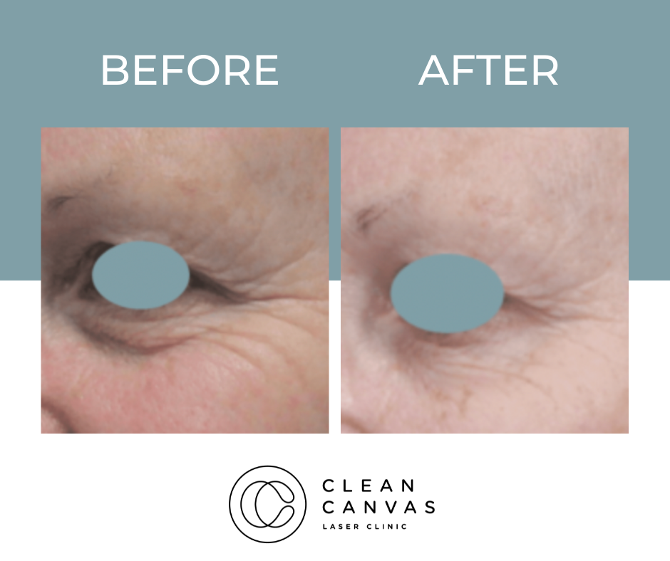 Before and after eye wrinkles