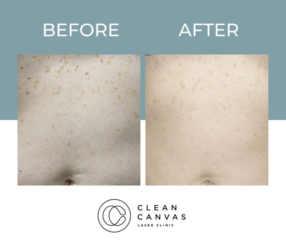 Freckle removal before and after
