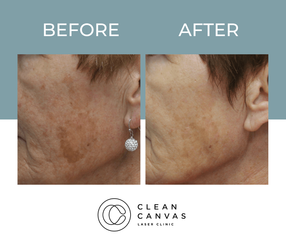 Birthmark on woman's face before and after removal