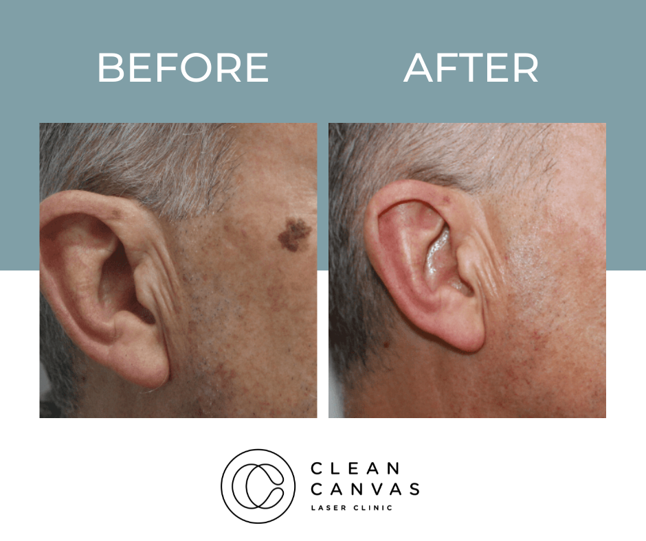 Before and after birthmark removal