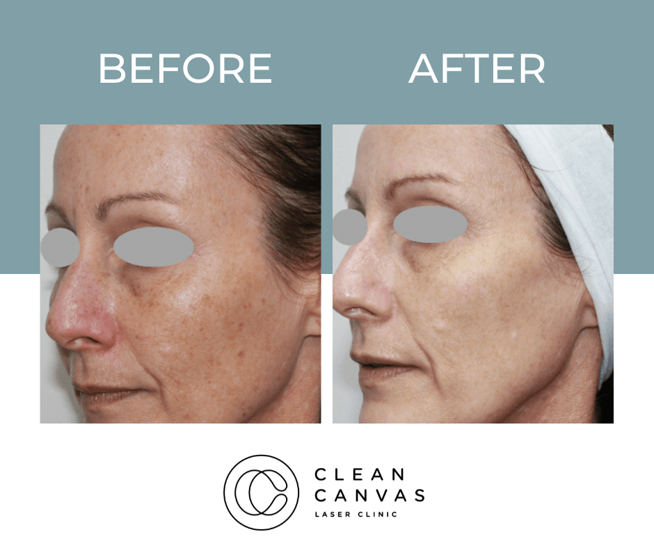Skin treatment on cheek before and after