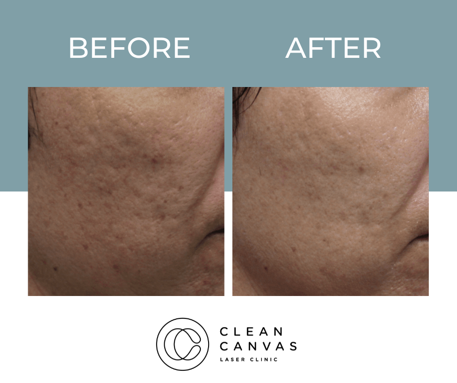 Skin treatment before and after