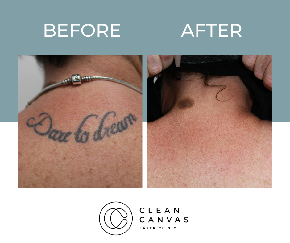 Dare to dream tattoo before and after tattoo removal image
