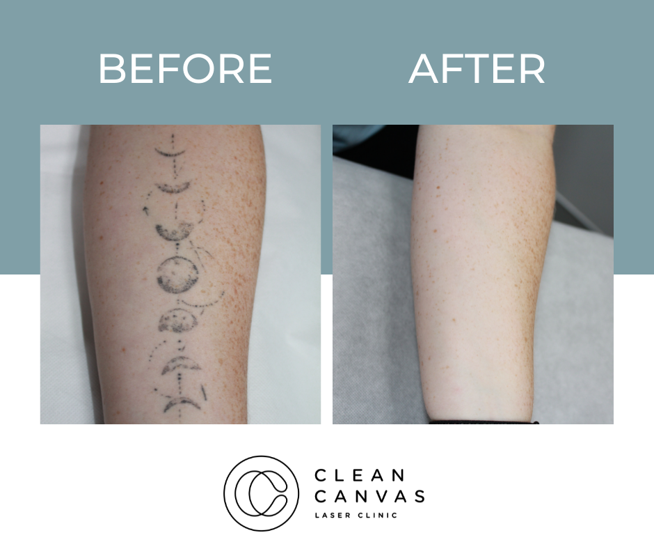 Arm tattoo before and after tattoo removal image
