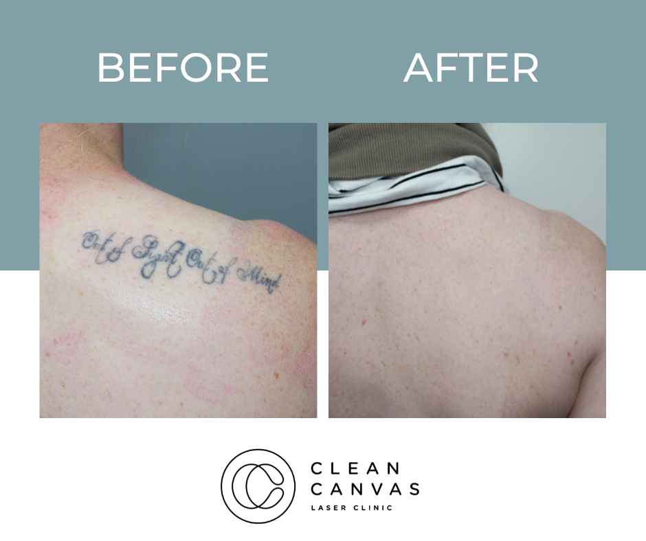 Script tattoo before and after image of removal