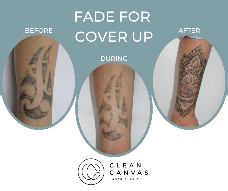 Tattoo Removal Before And After In Sydney - Clean Canvas Laser Clinic
