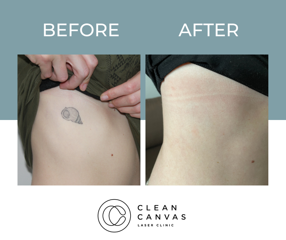 Shell tattoo before and after removal image