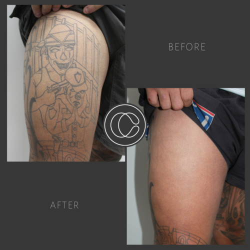 Leg Tattoo Removal Before And After