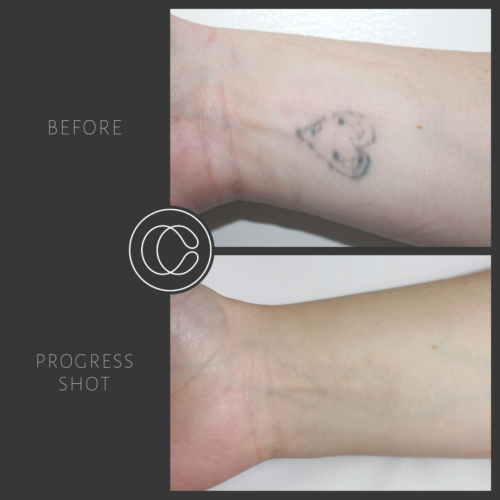 Small Wrist Tattoo Removal Before And After